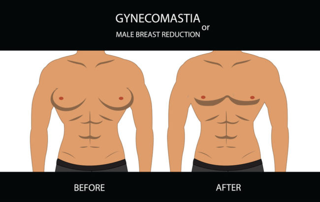 How To Get Rid of Gyno
