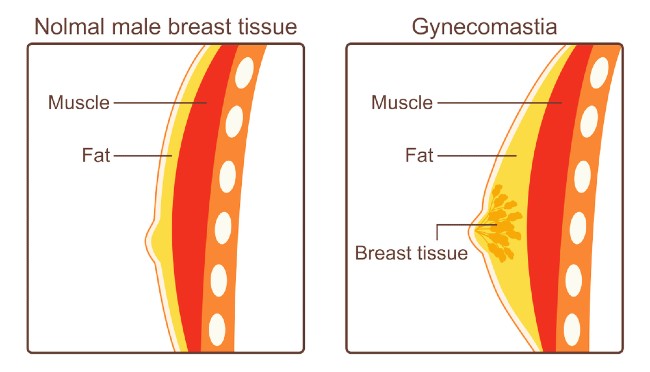 How To Get Rid Of Gyno